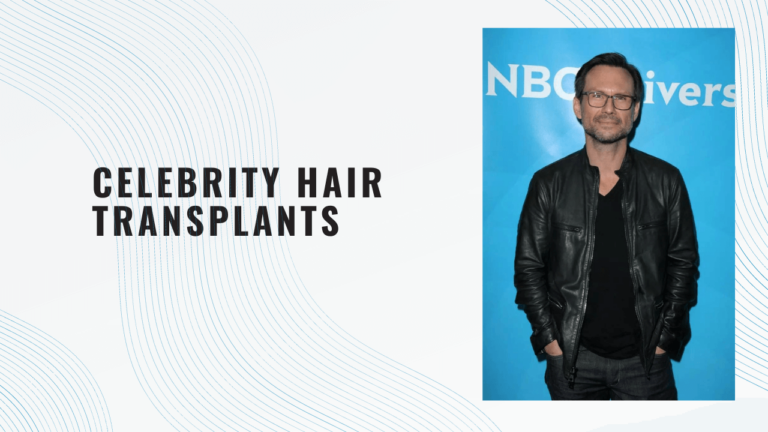 Celebrity Hair Transplants: Who’s Had Them?